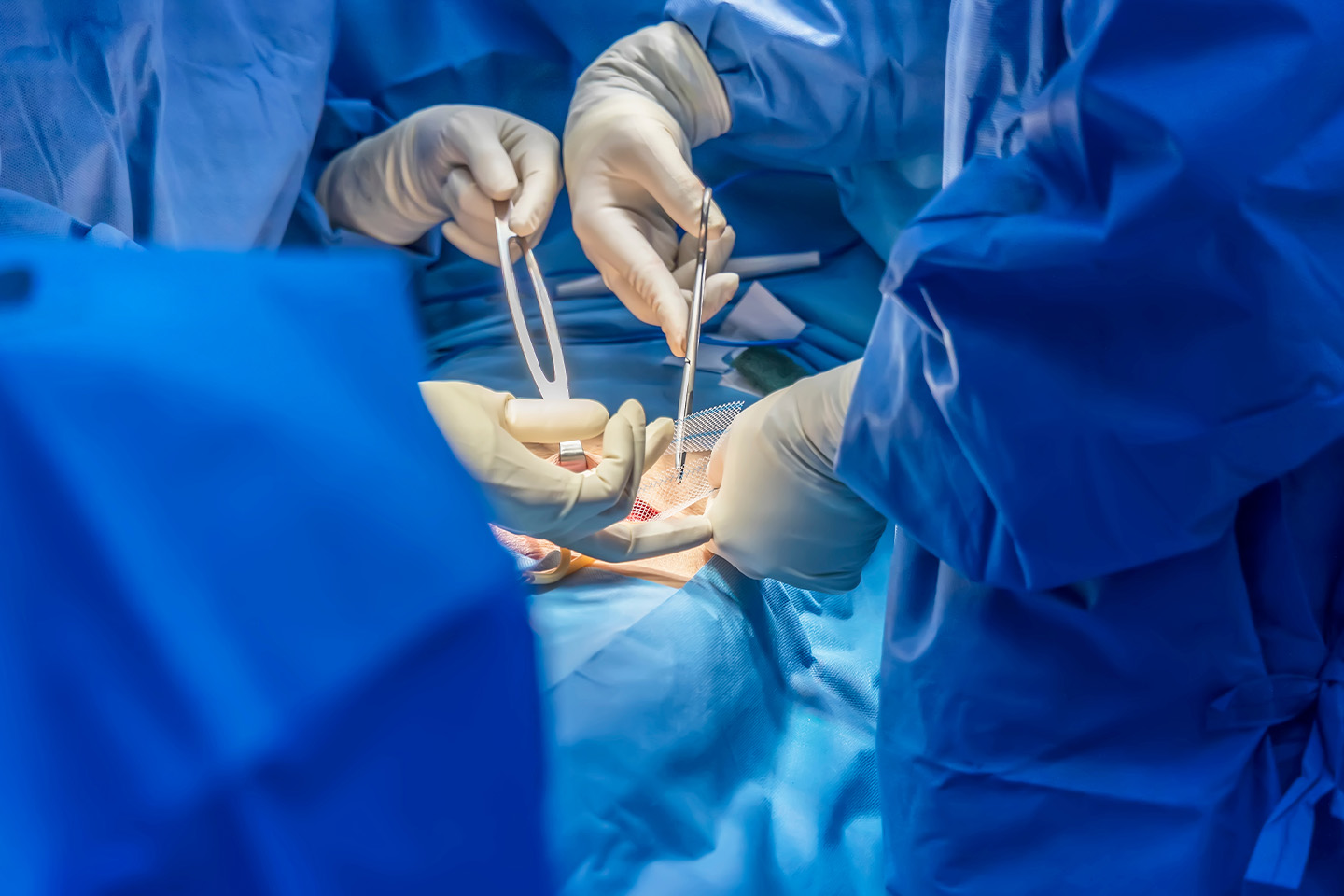 Mesh Selection in Hernia Surgery
