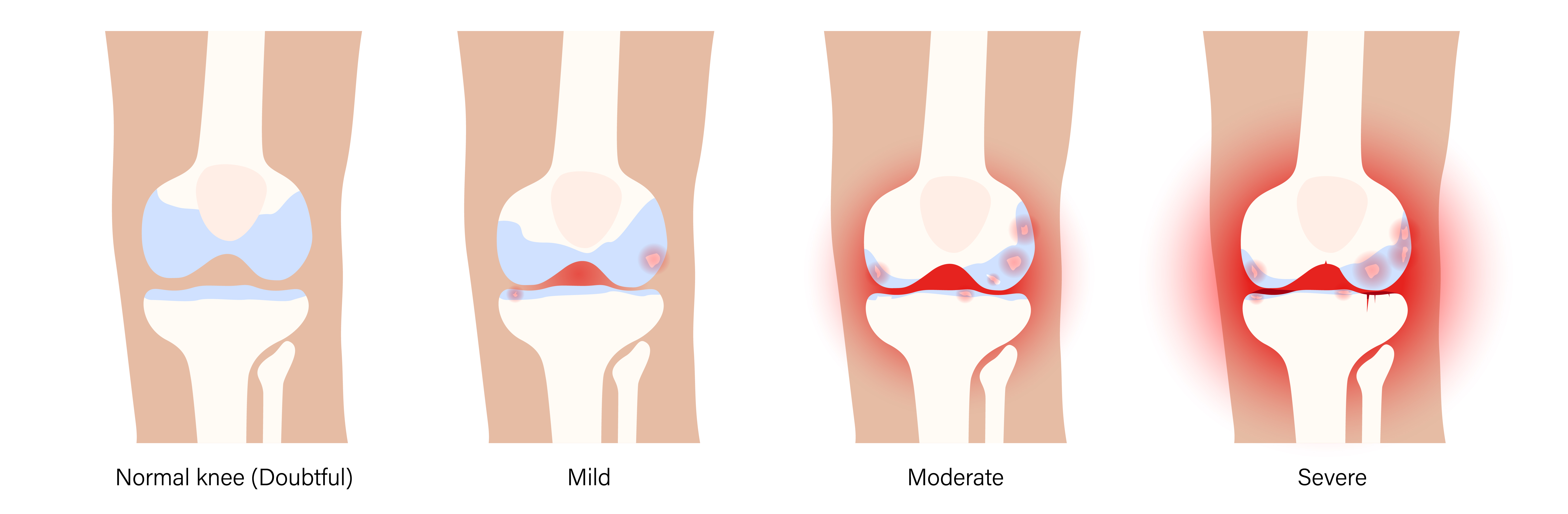 Difference between Osteoarthritis and Rheumatoid Arthritis