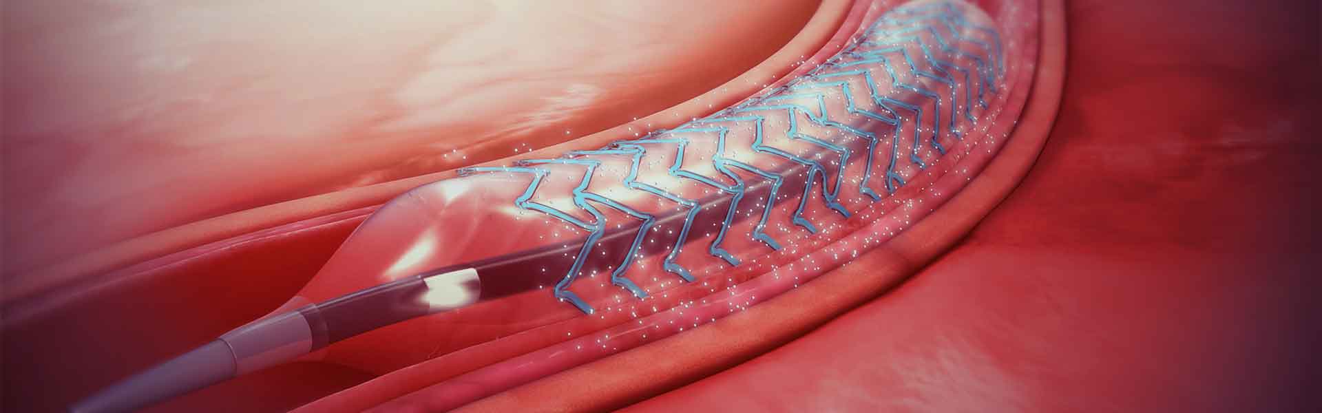 Better Option For Angioplasty