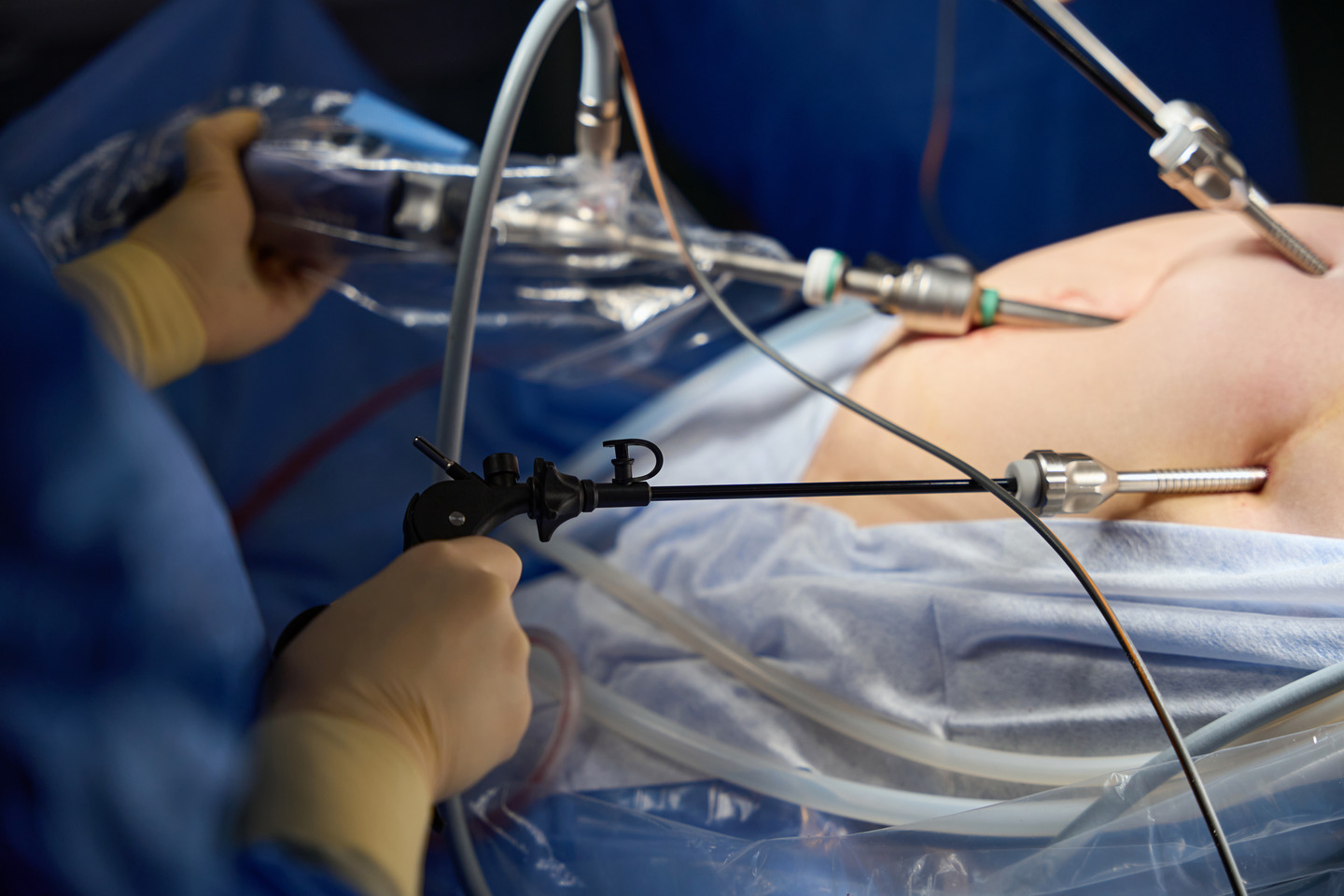 Bariatric Surgery