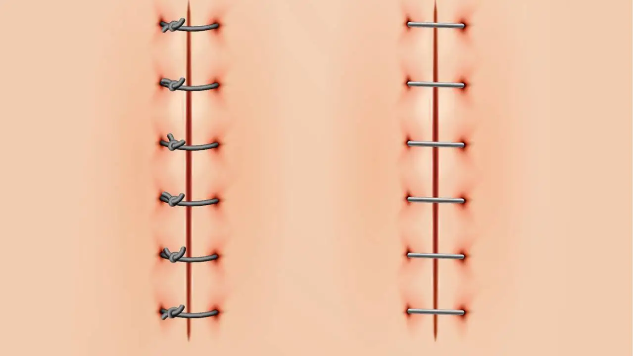 Sutures vs. Staples