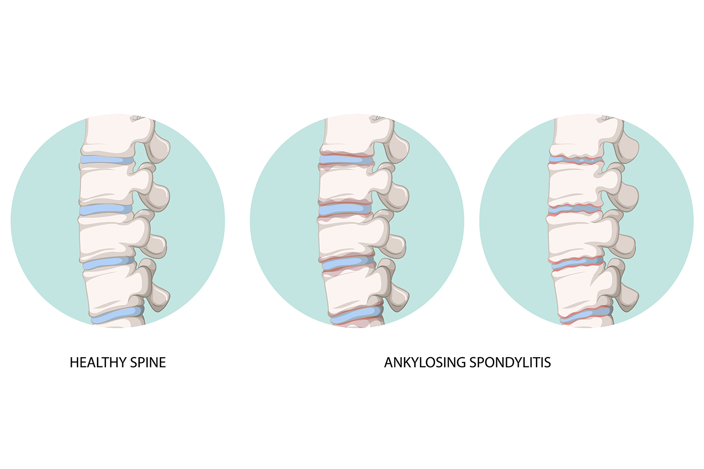 Different Types of Spondylitis