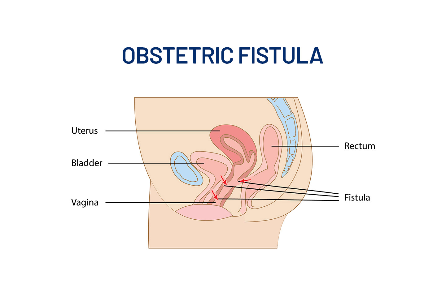 Obstetric Fistula