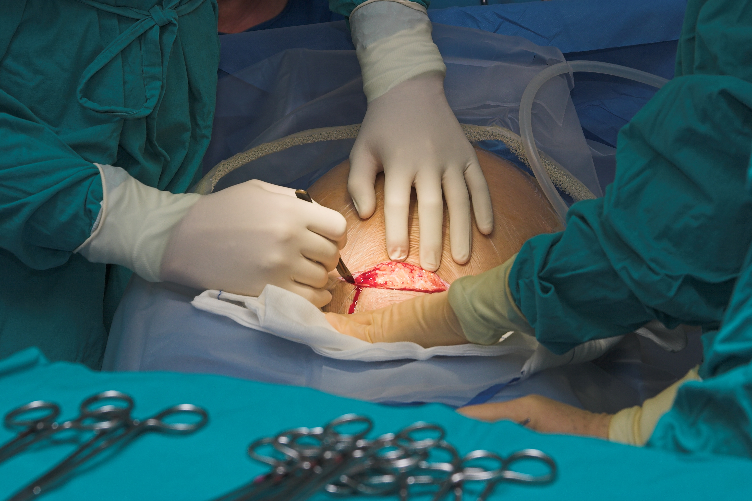 C-Section