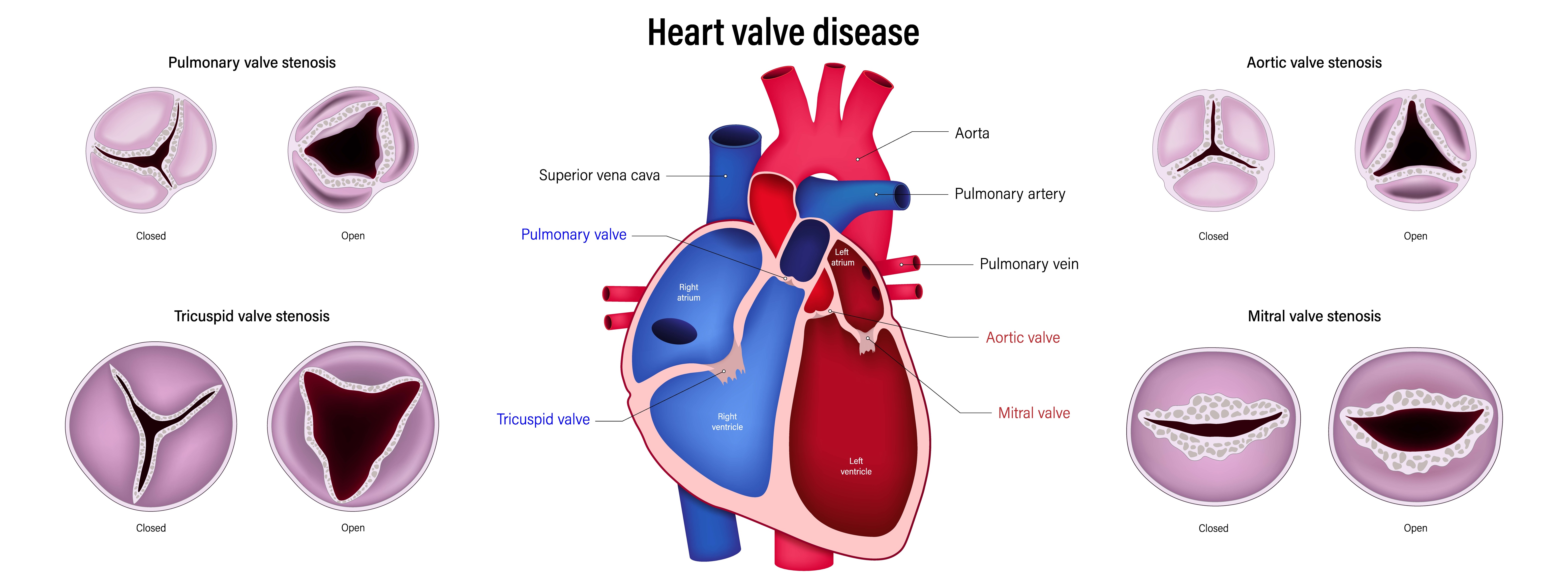 heart valve diseases and treatment