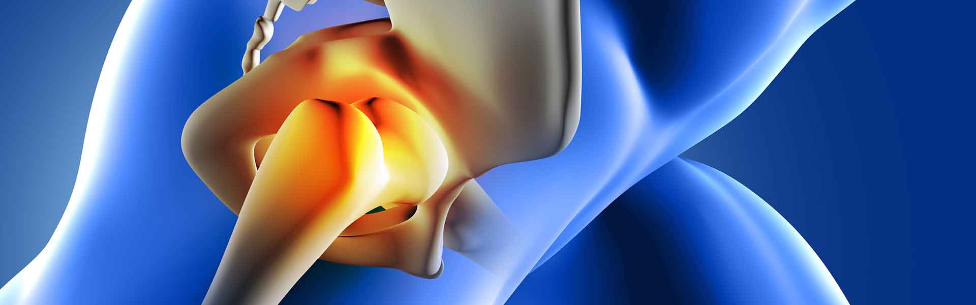 What Is A Hip Replacement