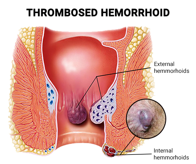 Thrombosed Hemorrhoid