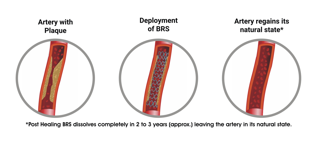 The Advantages of Bioresorbable Vascular Scaffolds explained! 