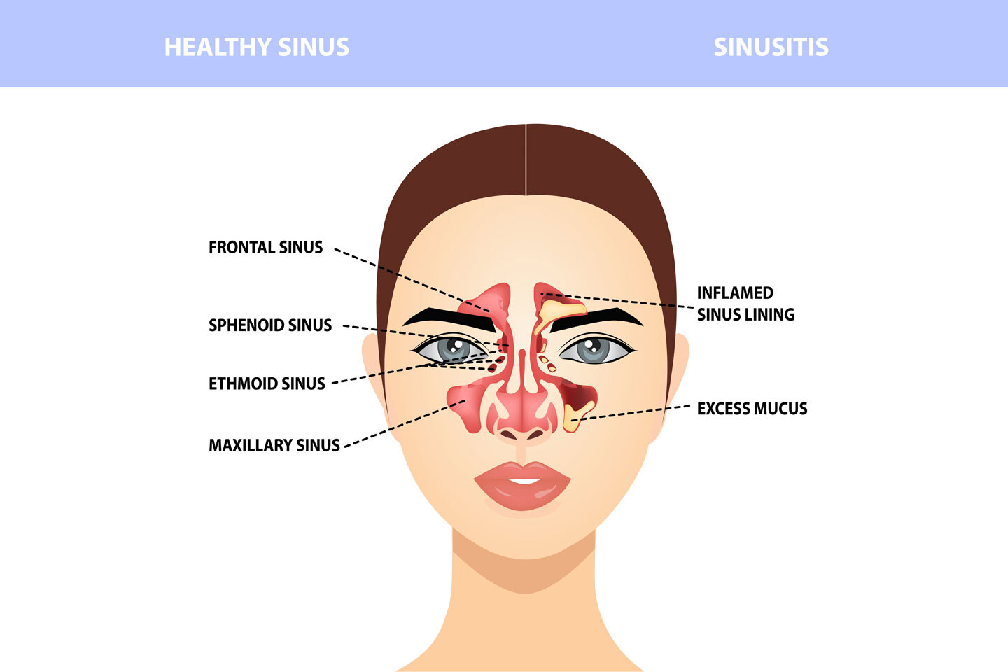 Sinus: Causes & Symptoms