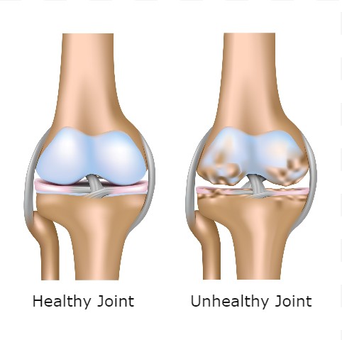 Rheumatoid Arthritis: What Is It?