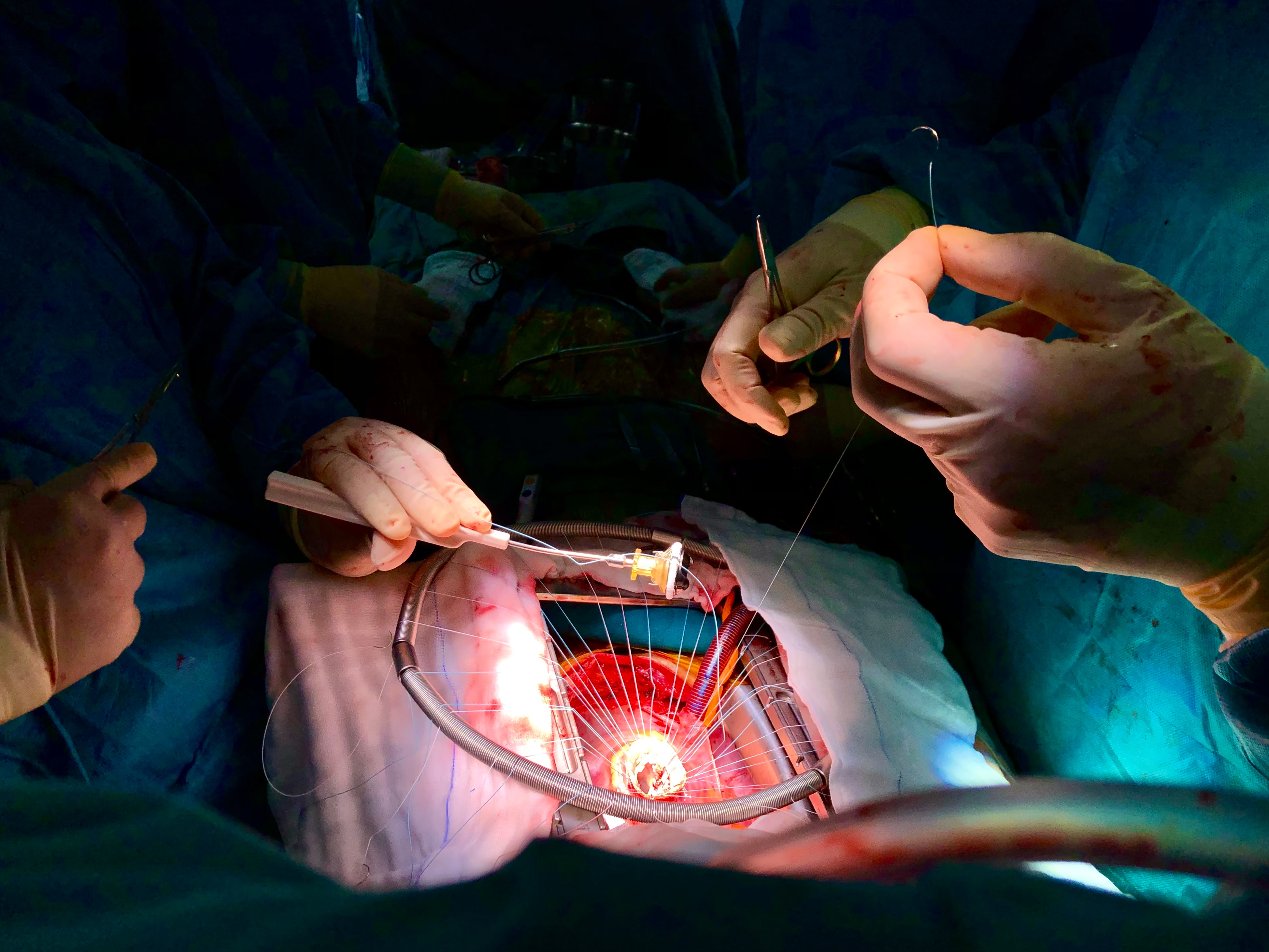 Heart Valve Replacement