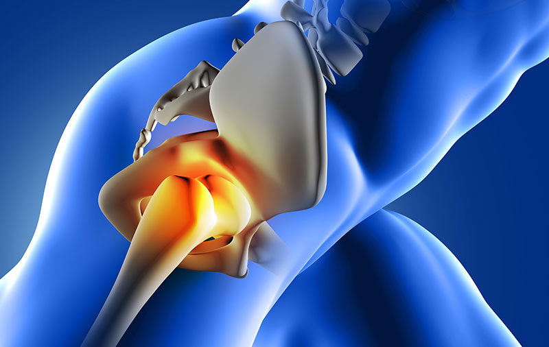 What Is A Hip Replacement?