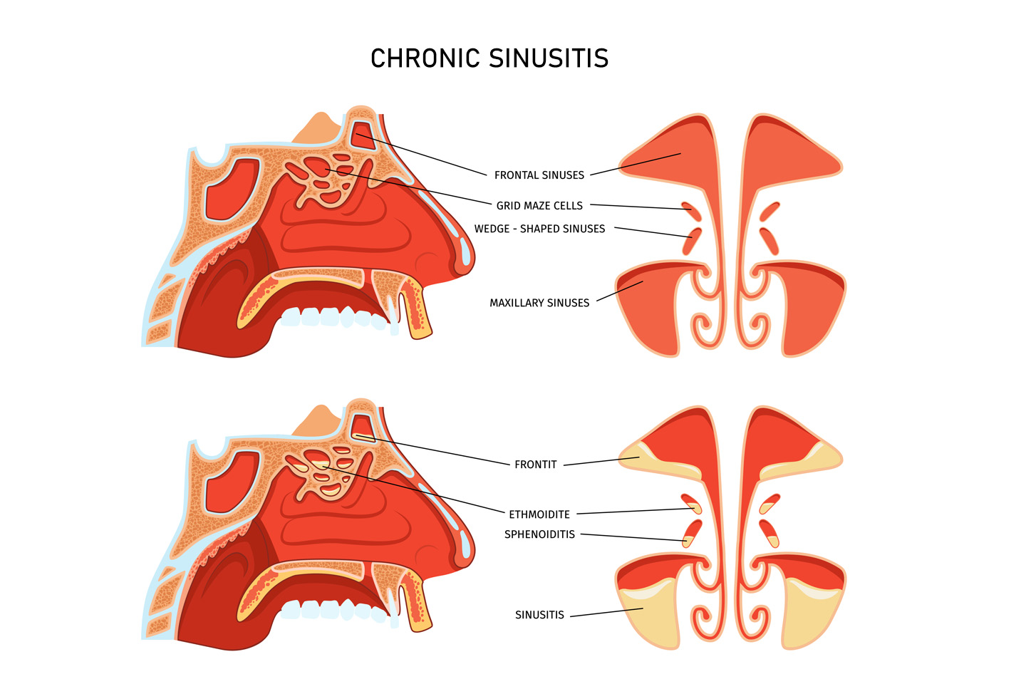 Everything You Should Know About Chronic Sinusitis