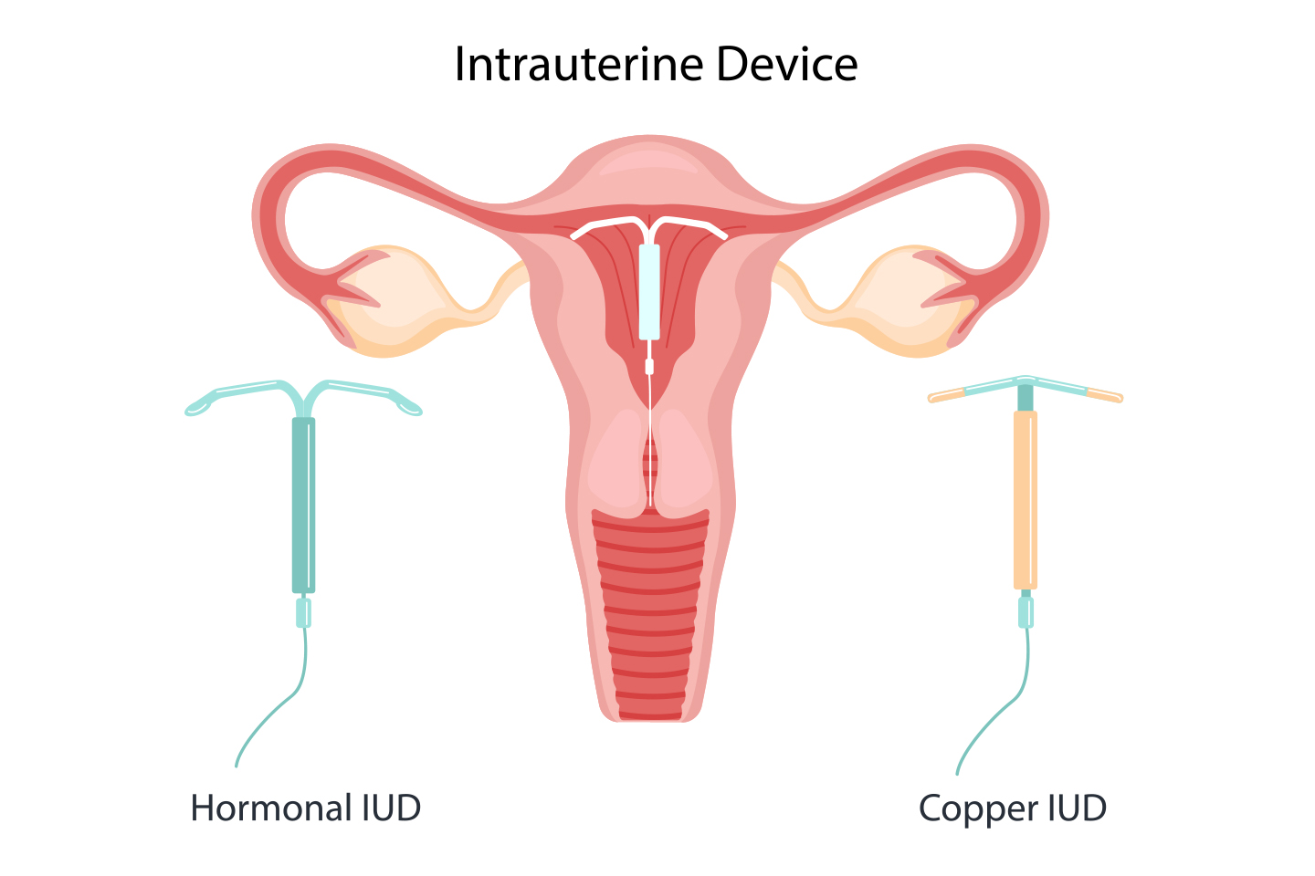 Things to Know About Intrauterine Devices