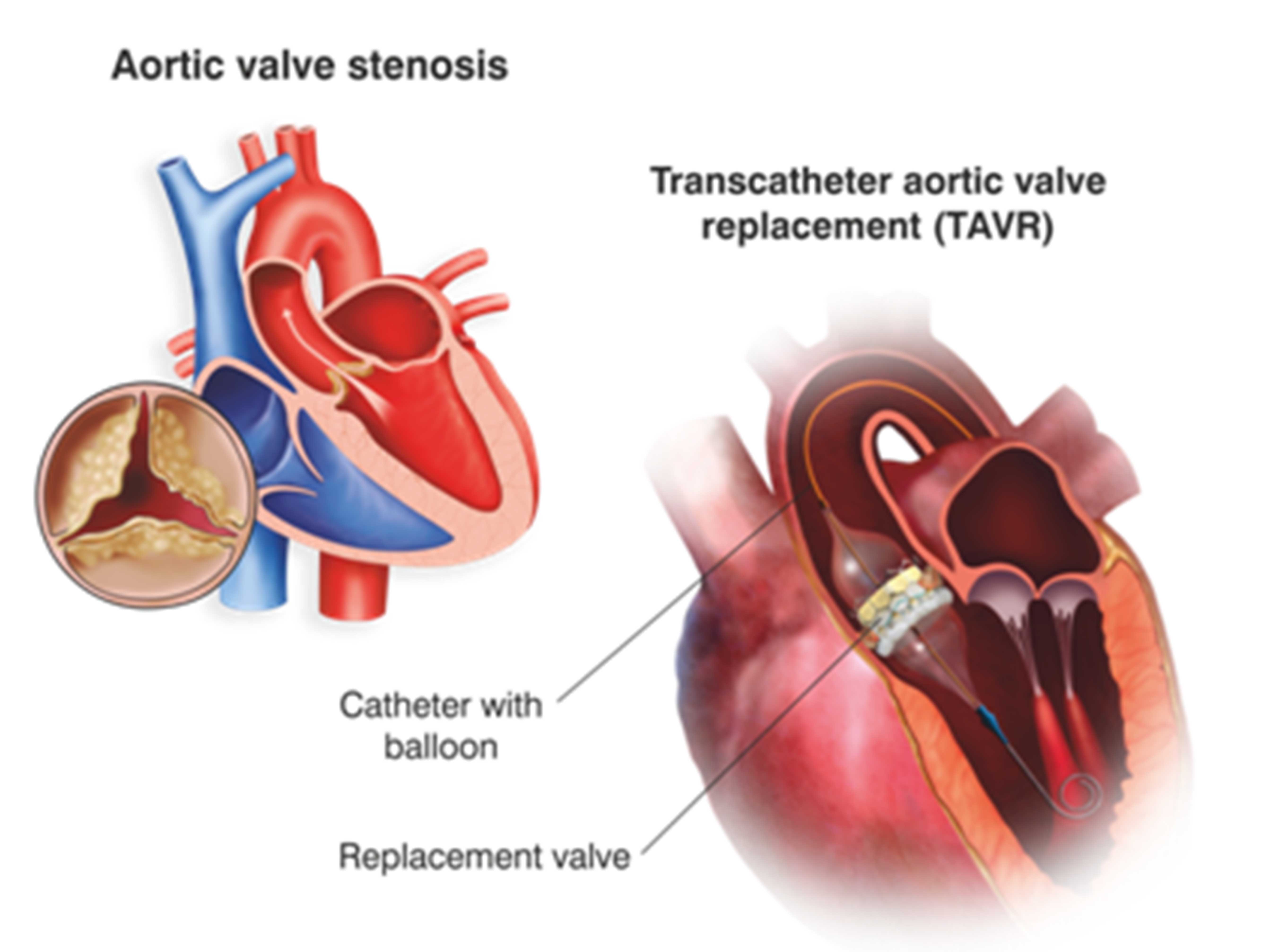 What is TAVR?