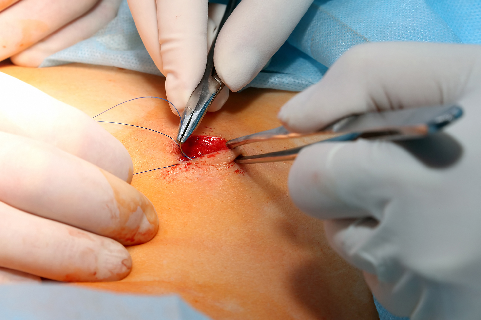 Absorbable Sutures