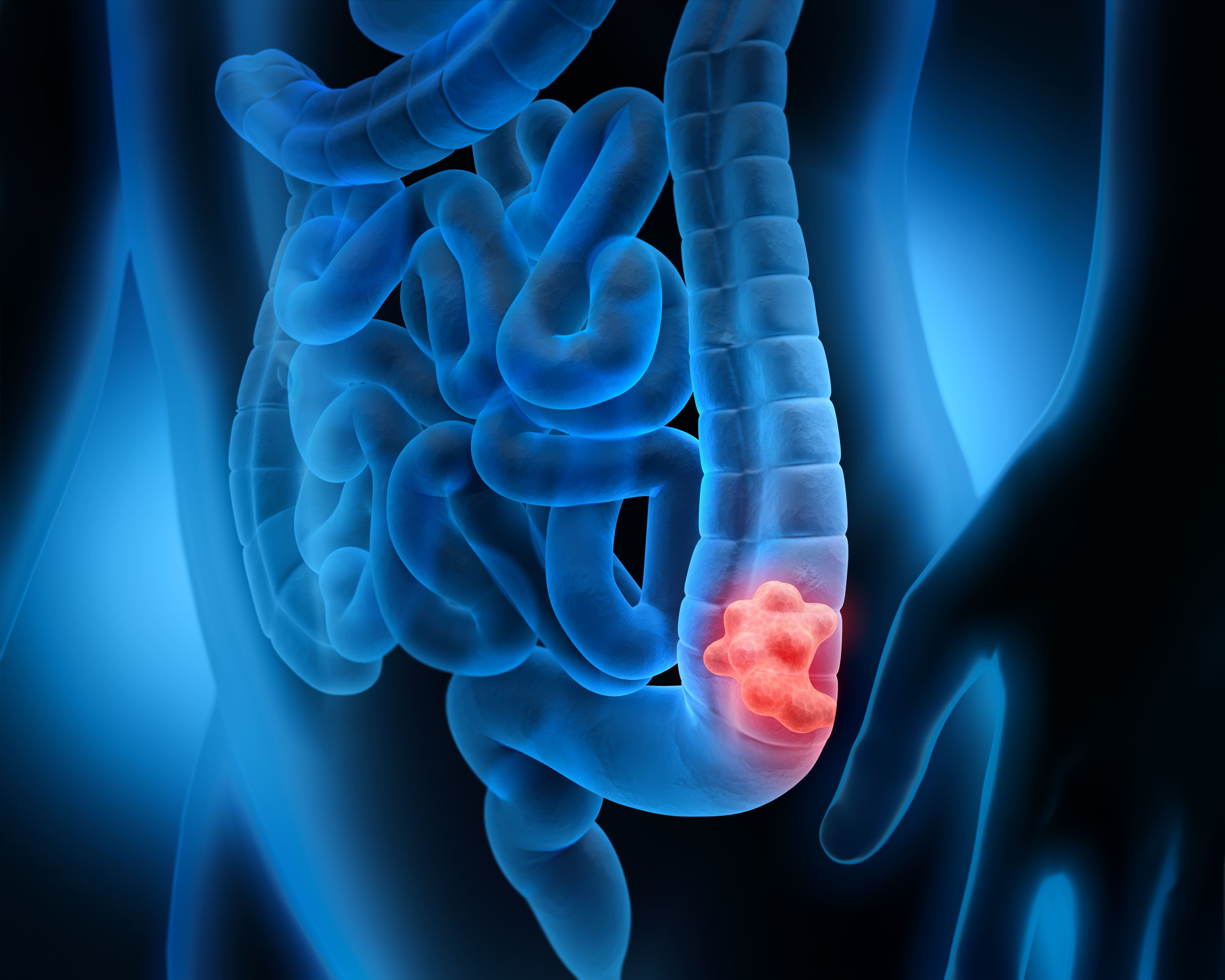 What Symptoms of Colon Cancer Emerge in Men and Women
