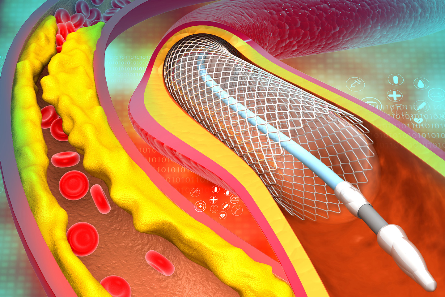 All you need to know about Percutaneous Coronary Interventions