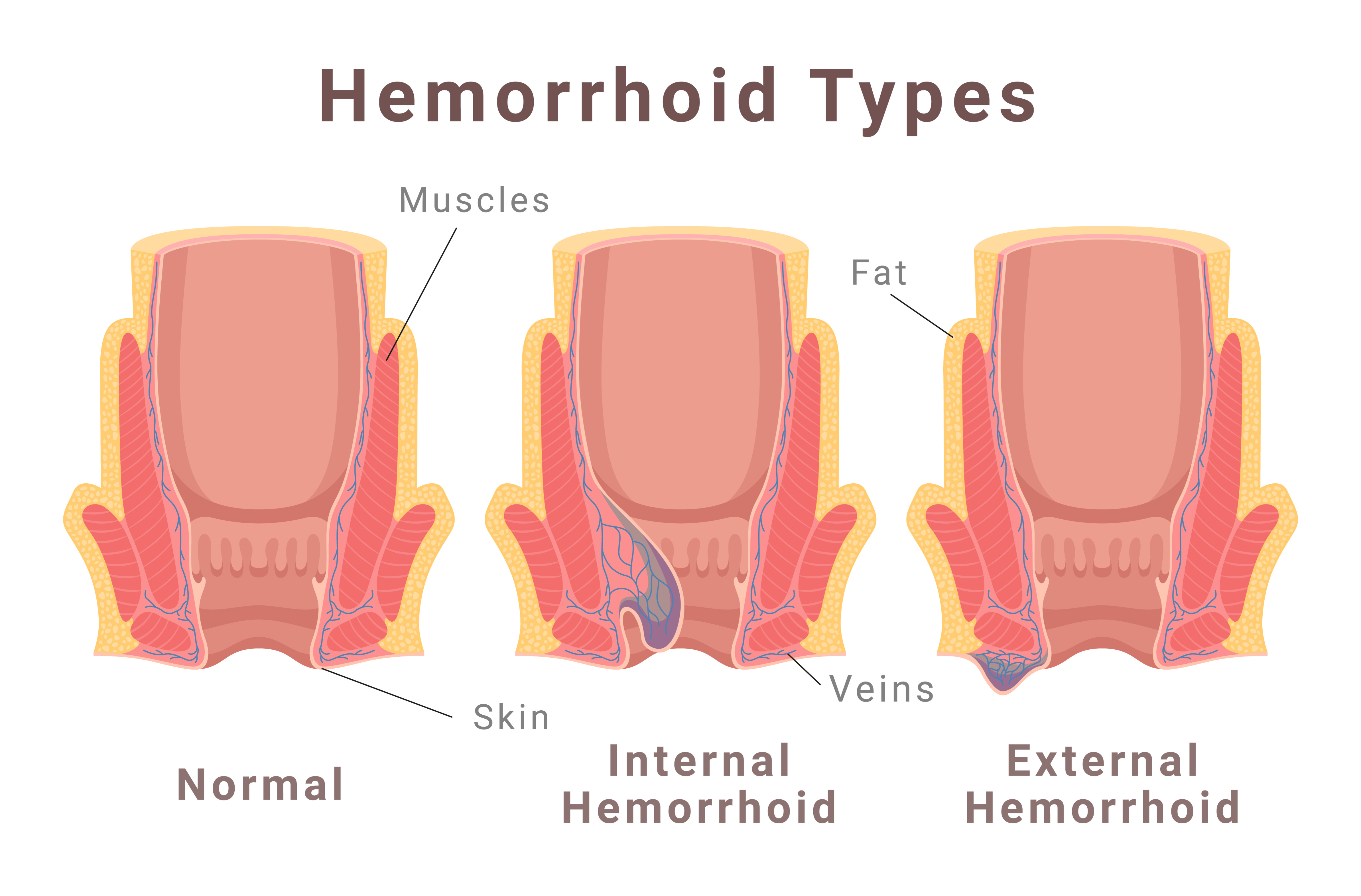 Types of Surgeries to treat Hemorrhoids