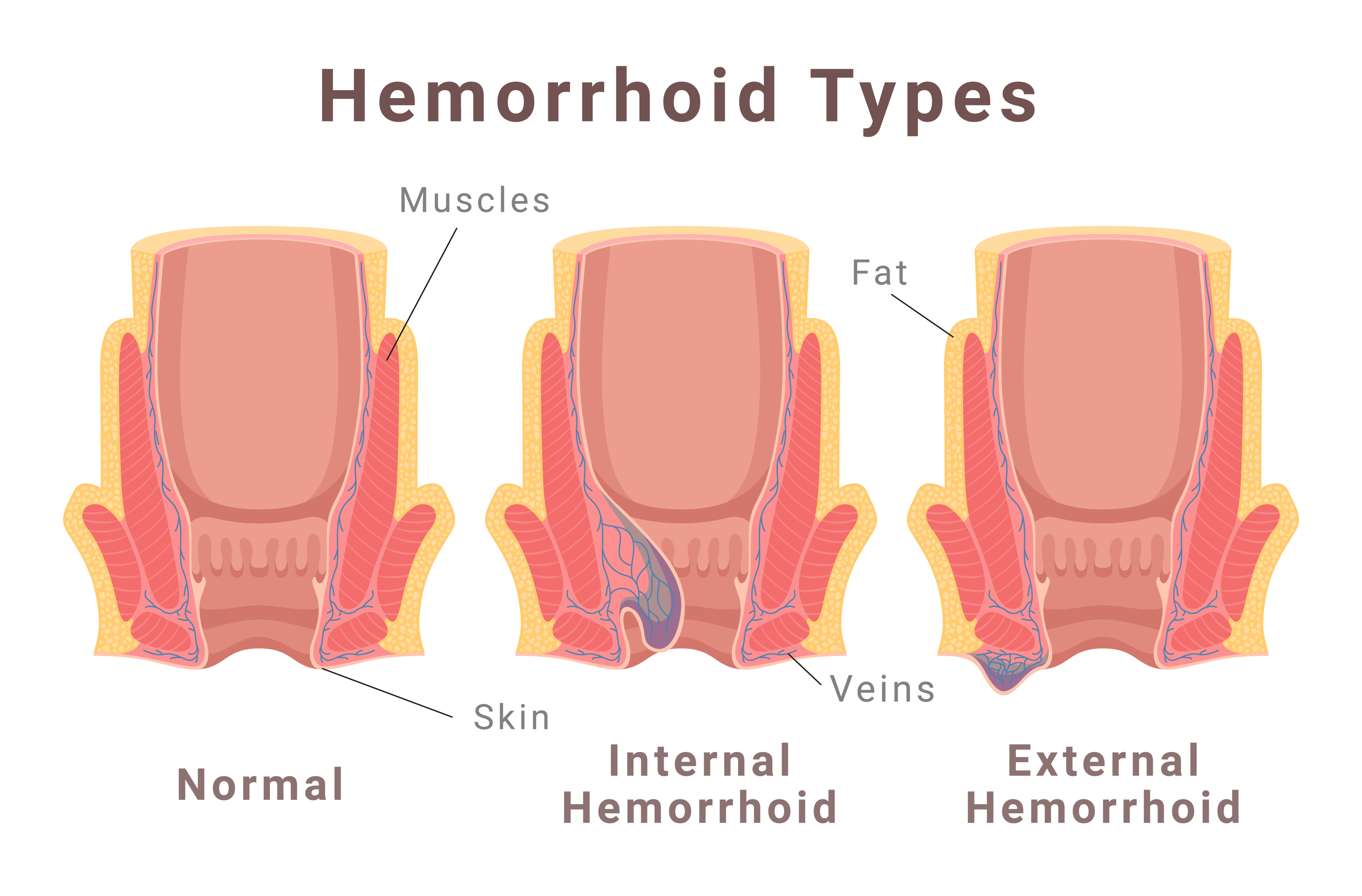 Surgical treatment of Piles / Hemorrhoids