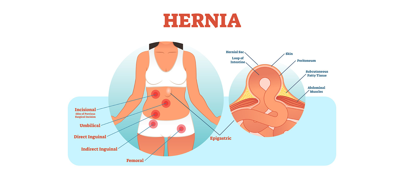 Hernioplasty