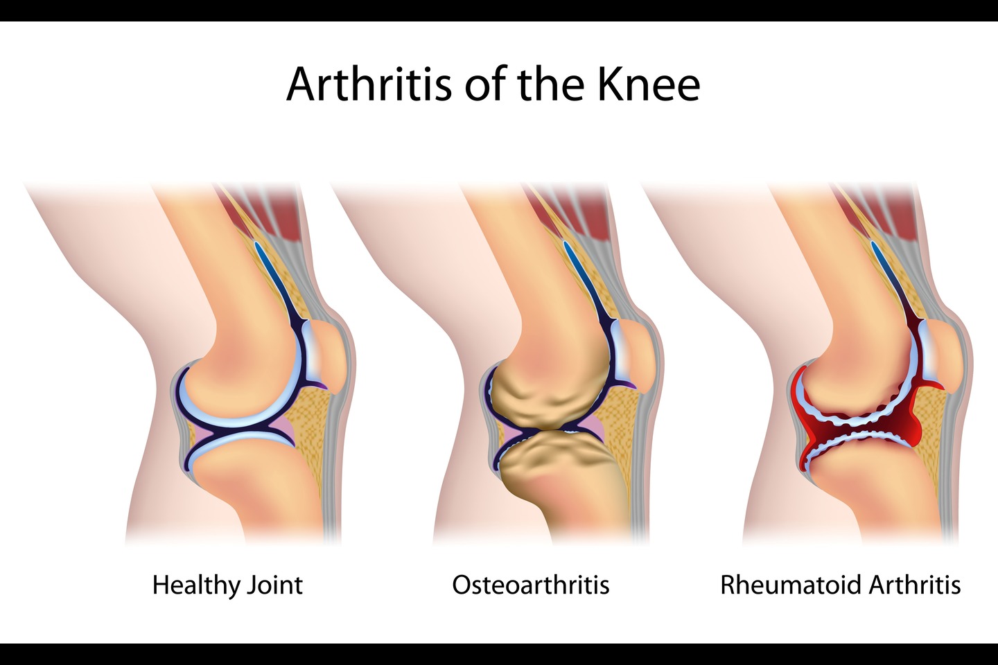 World Arthritis Day: Symptoms, Risks, and Treatment