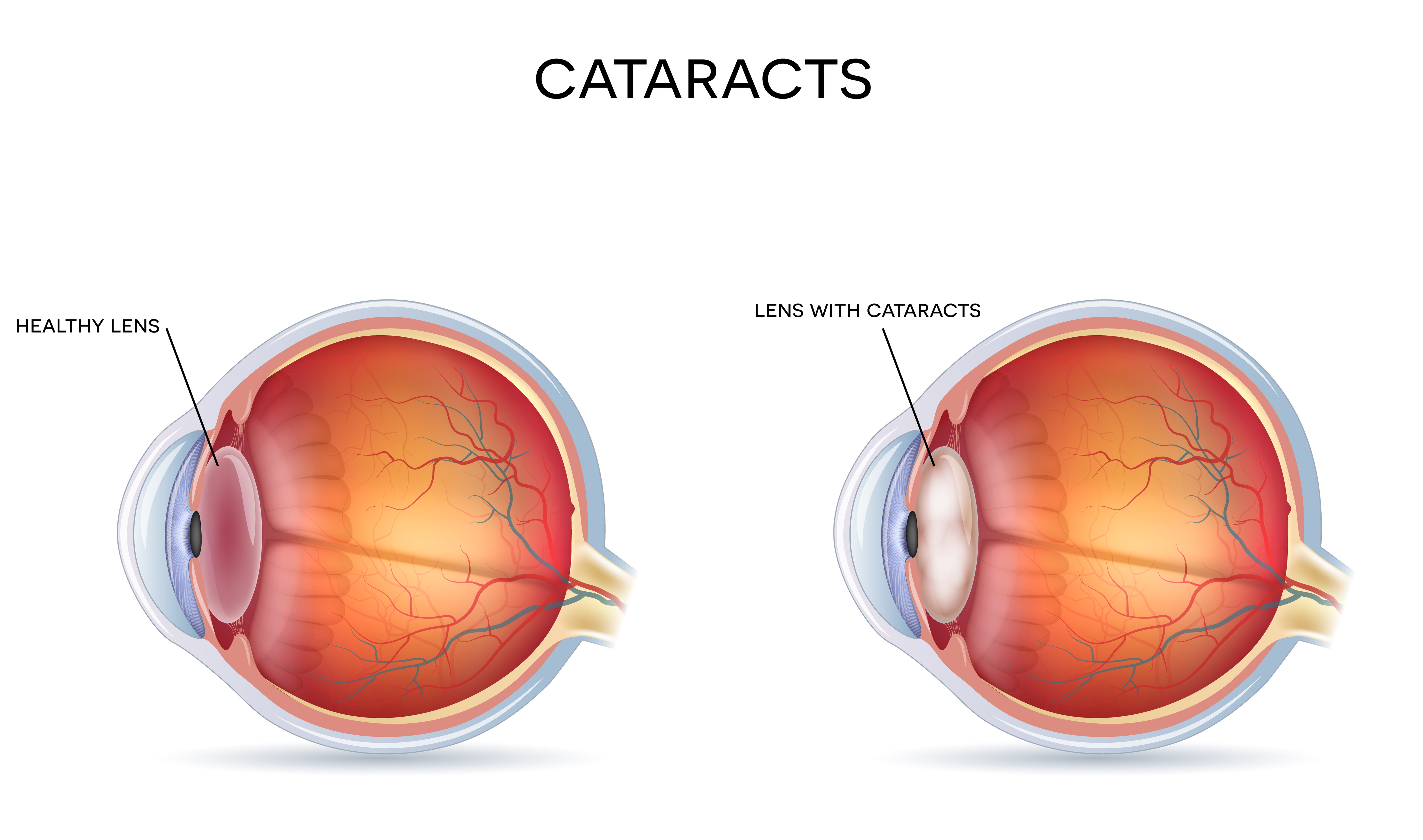 Cataract Surgery - Risks, Treatment and Recovery