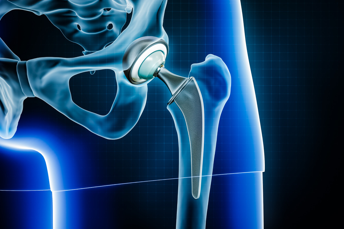 Types of Hip Replacement surgery