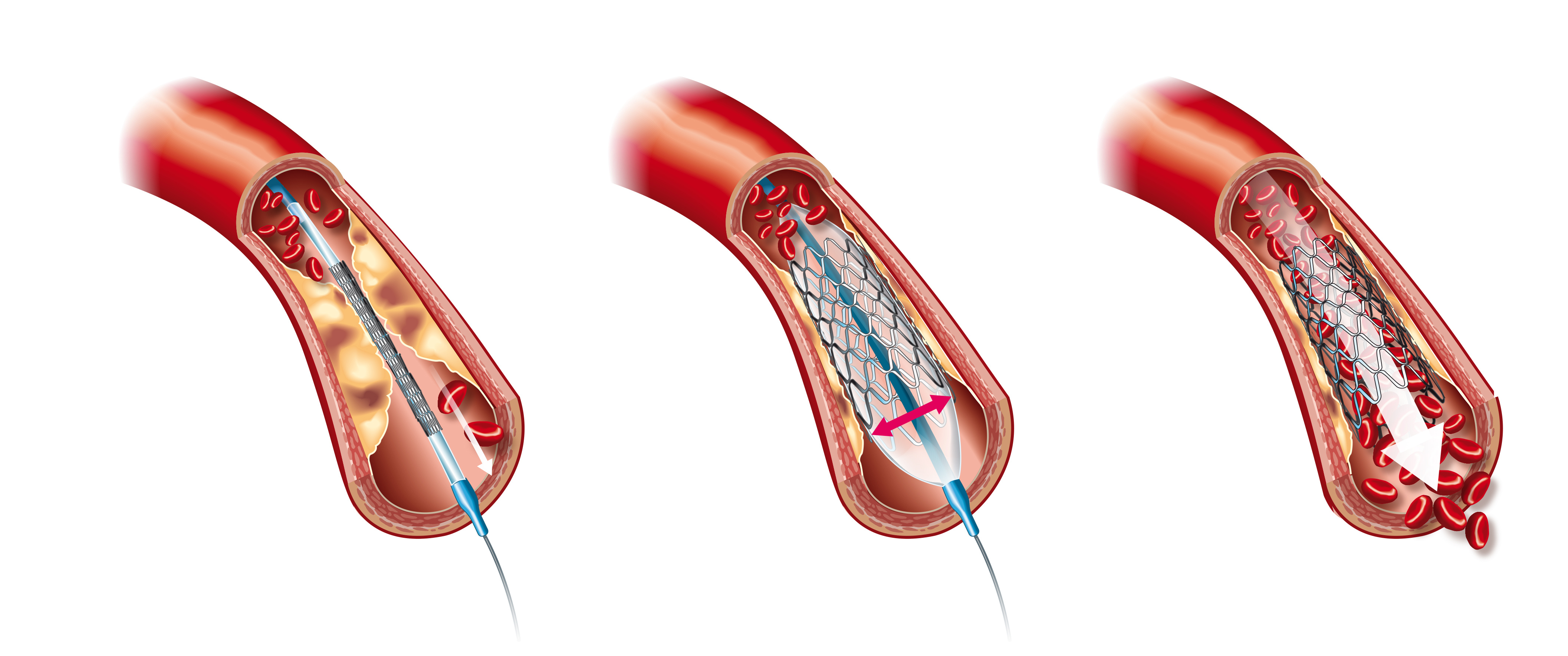 BIORESORBABLE SCAFFOLDS -  The New Age Dissolving Stents