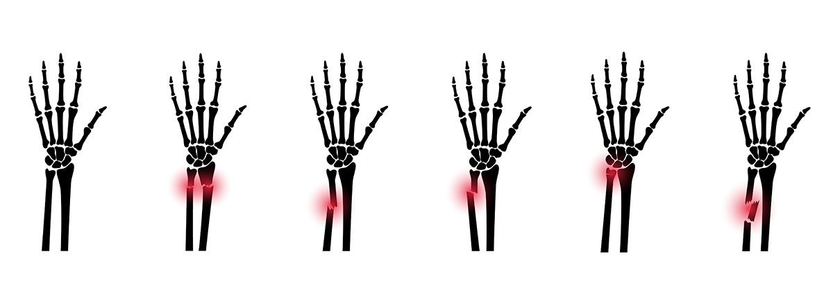 Distal Radius Fracture