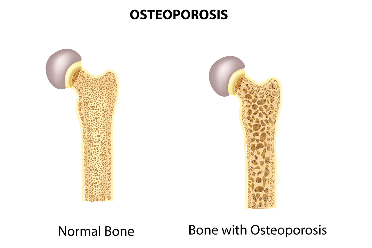 All You Need to Know About Osteoporosis