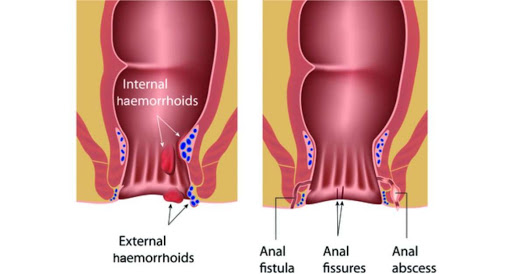 Anal treatment