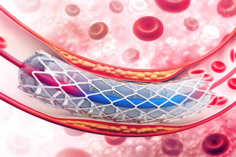 Drug Eluting Stent What is It & How It is Implanted