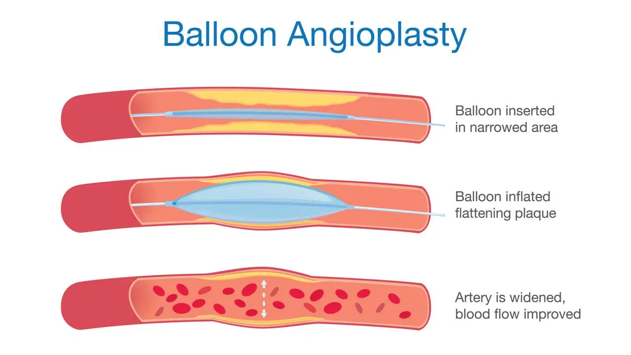 Types of Coronary Stents