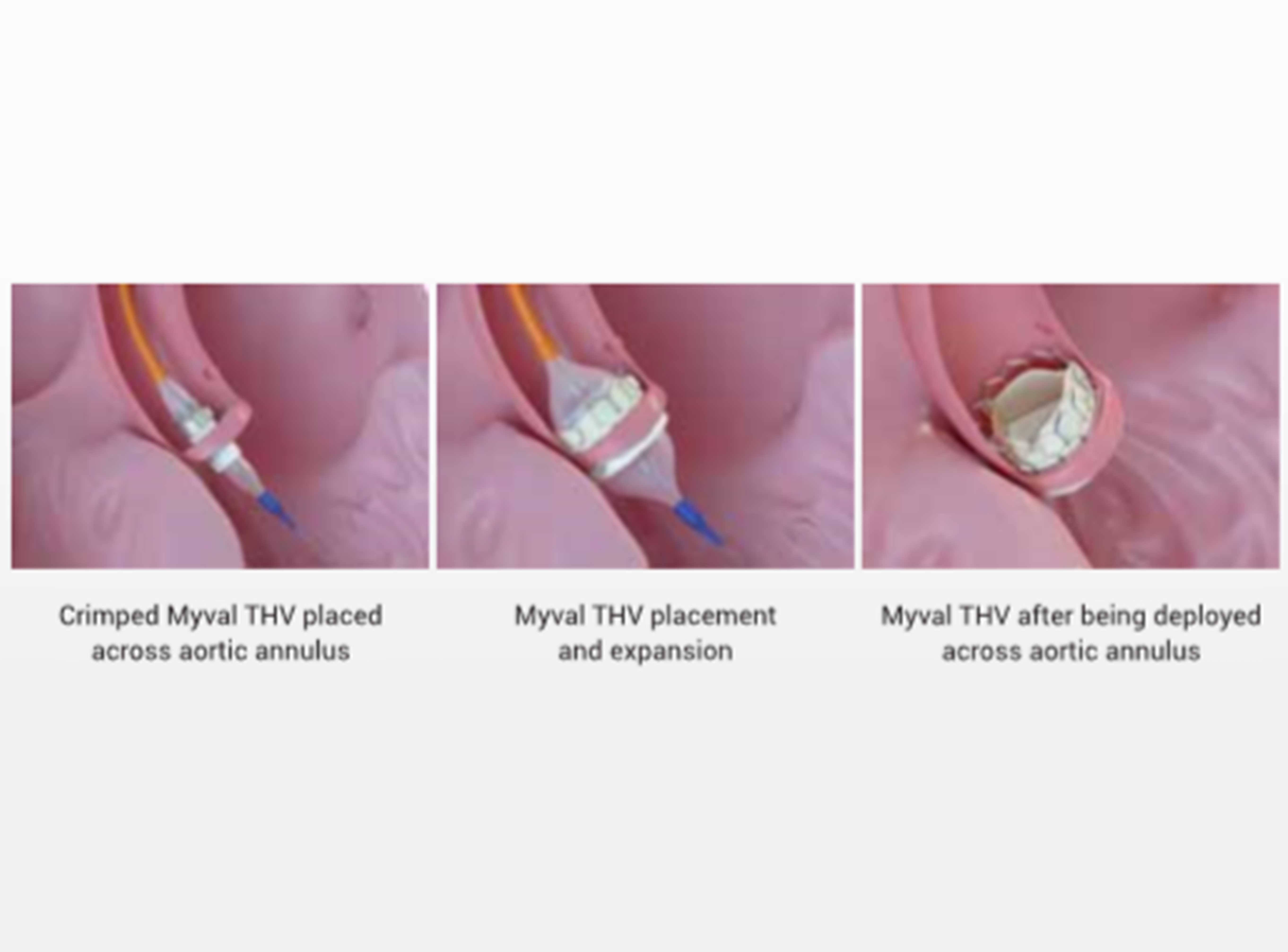 TAVR: A powerful ally in the battle against Aortic Valve Stenosis