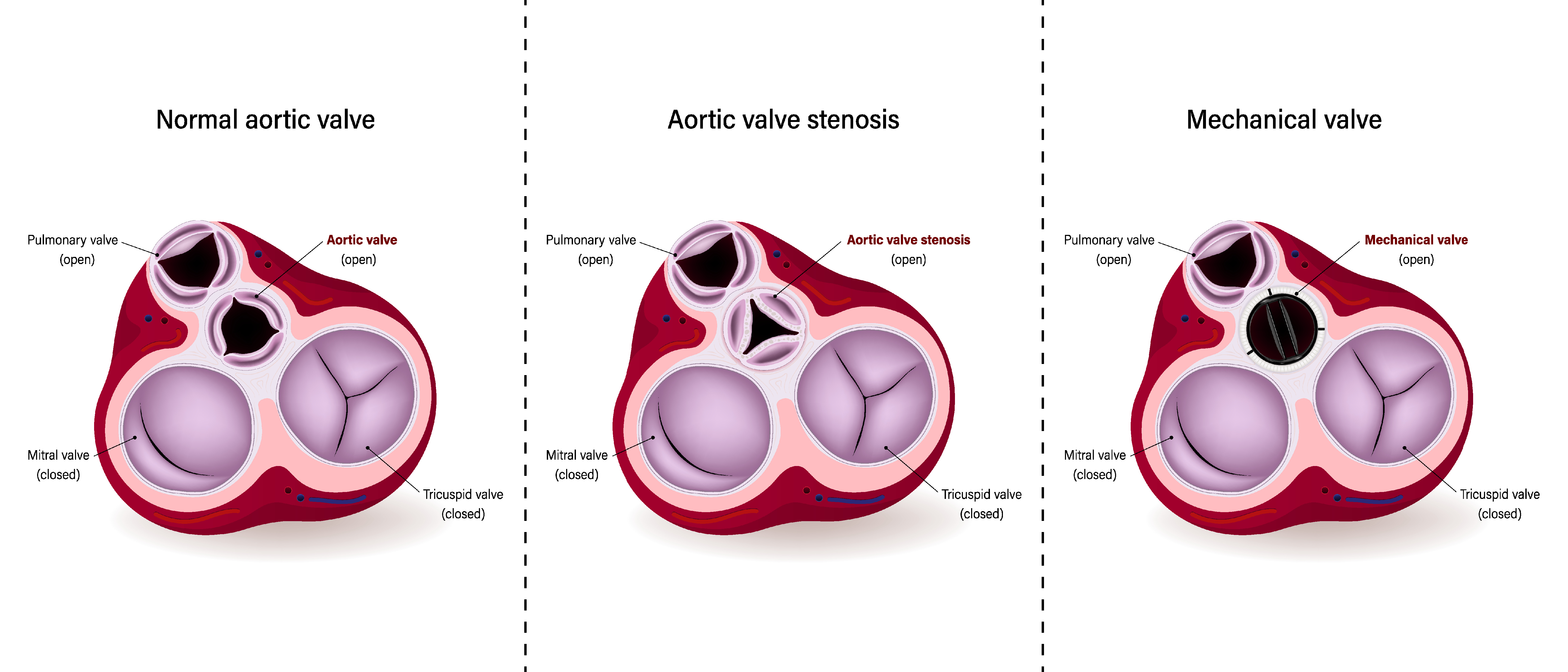 Aortic Valve Replacement Surgical