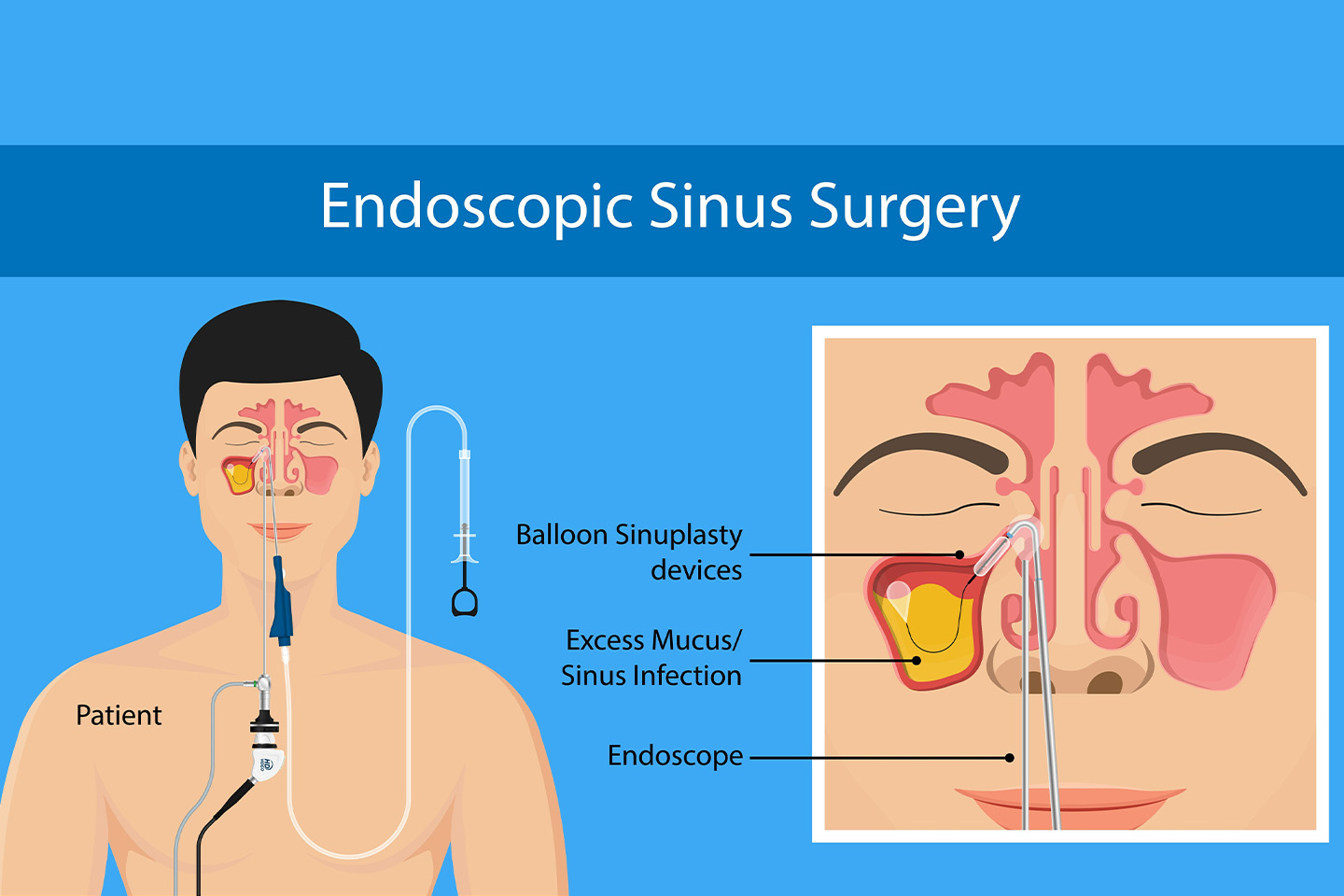 Novel Advancements in Sinus Surgery for Positive Outcomes and Speedy Recovery