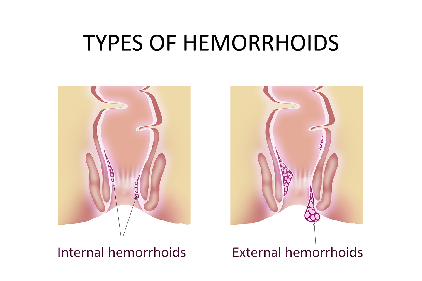 Piles: Symptoms, causes, and treatments