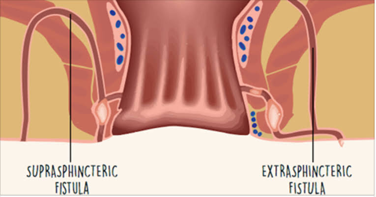 The 3 Most common types of Fistula