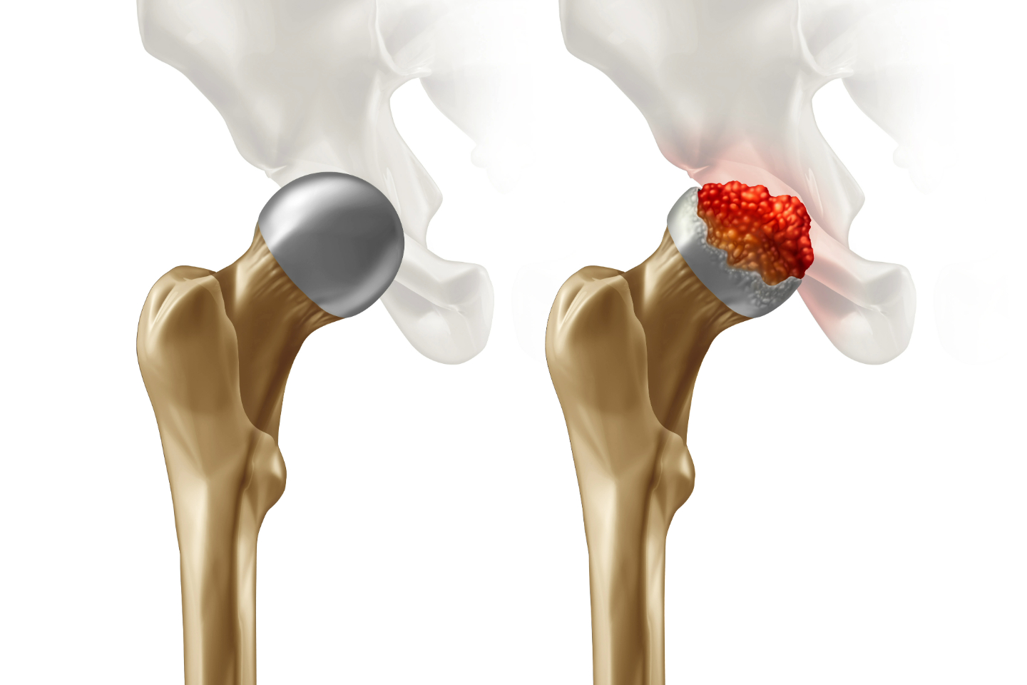 Avascular Necrosis Treatment using Direct Anterior Approach (DAA)