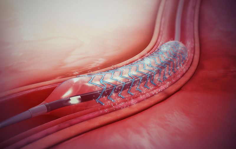 What Is A Better Option For Angioplasty? A Bare Metal Stent Or A Drug Eluded Stent?