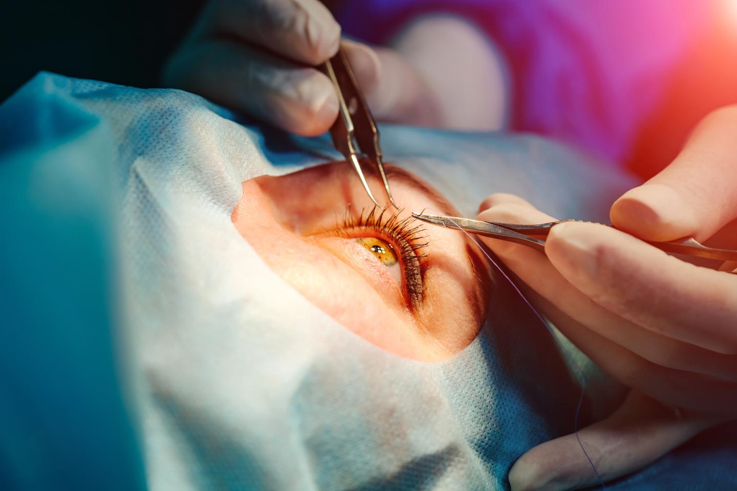 Cataract Surgery: Causes, Prevention, Diagnosis & Types