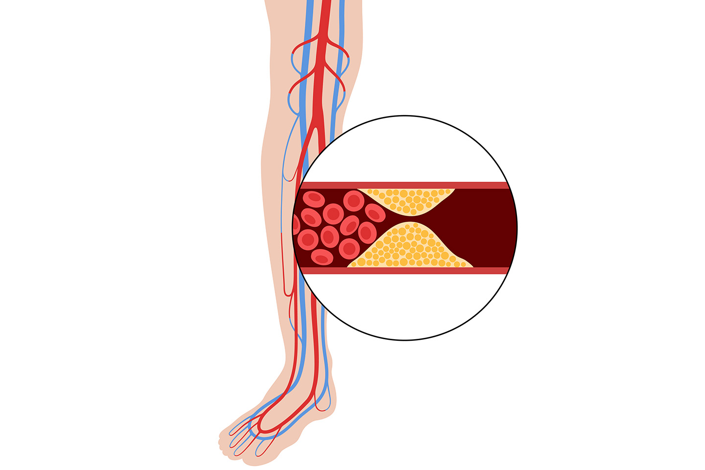 Knee (BTK) scaffolds