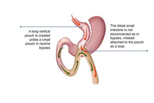 Mini Gastric Bypass surgery is performed under general anaesthesia.