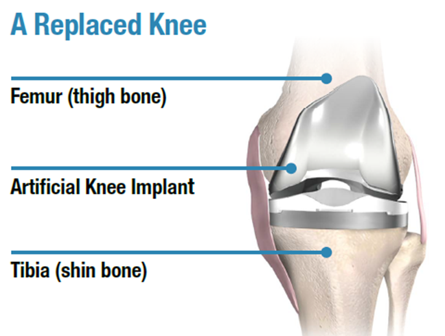 Implanting prosthesis in Total Knee Replacement