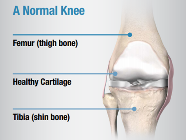 Shockwave therapy - how is it used to treat heel pain?