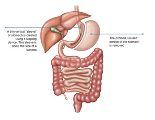 Detailed Guide on Sleeve Gastrectomy