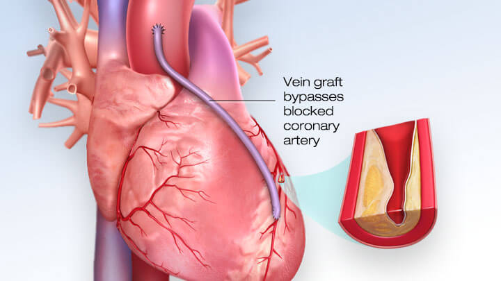 Coronary Artery Bypass Surgery