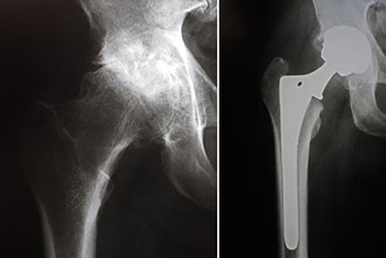 Detailed Guide on Hip replacement surgical procedure.