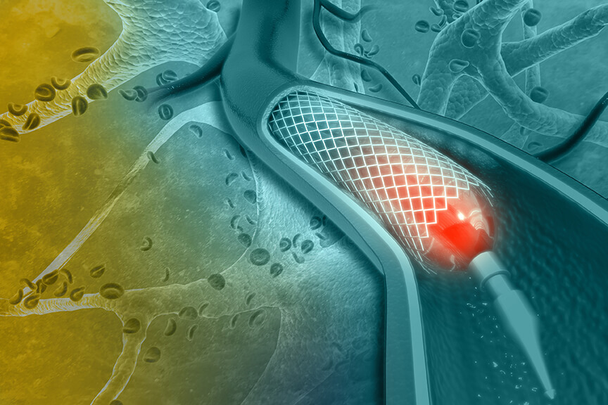 Coronary Angioplasty Procedure